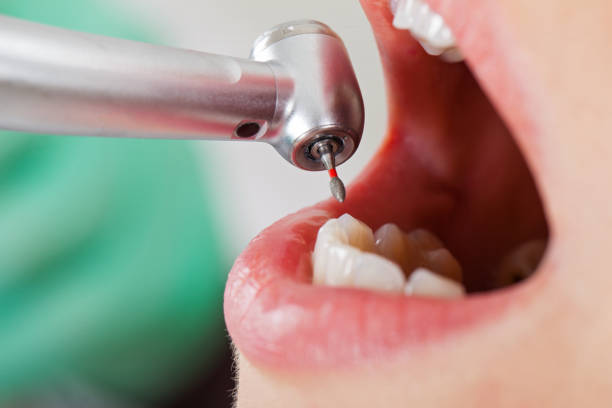 Best Emergency Root Canal Therapy in Mason Neck, VA